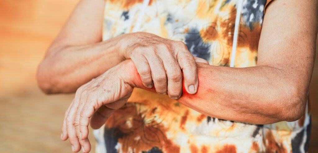 sclerodermia