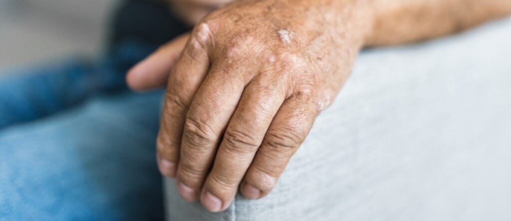 artrite psoriasica santagostino monza