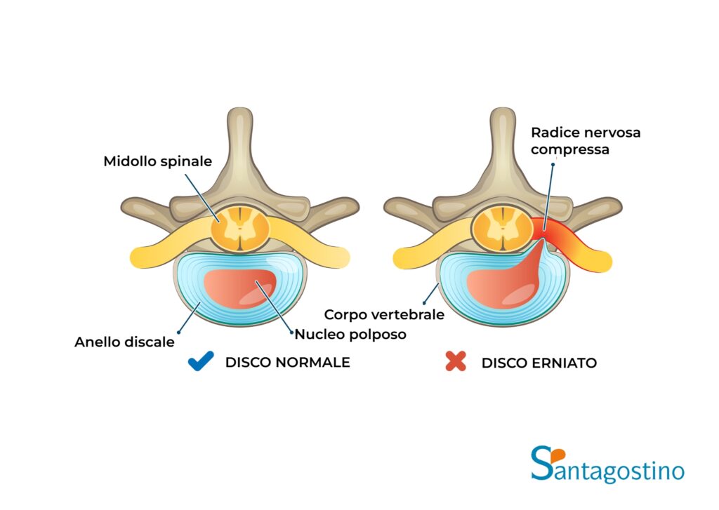 Ernia Del Disco Cause Sintomi Diagnosi E Trattamento Santagostino 