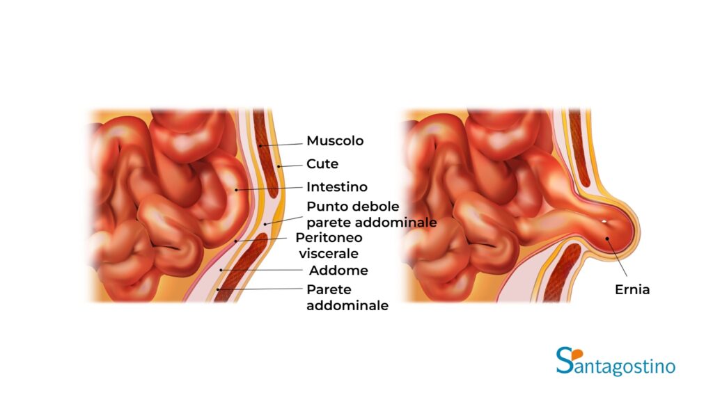 anatomia ernia addominale