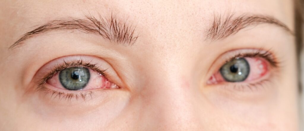 congiuntivite allergica santagostino monza