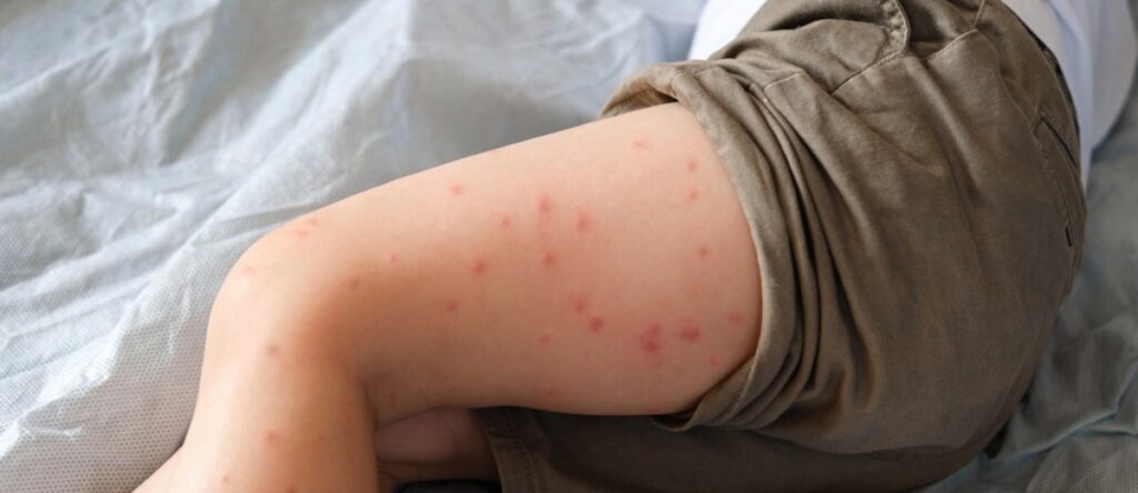 morbillo santagostino monza