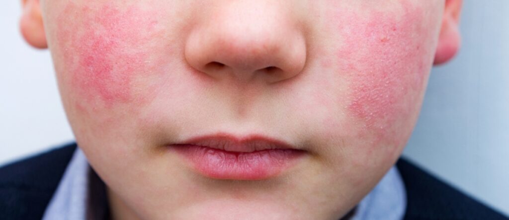 quinta malattia santagostino monza