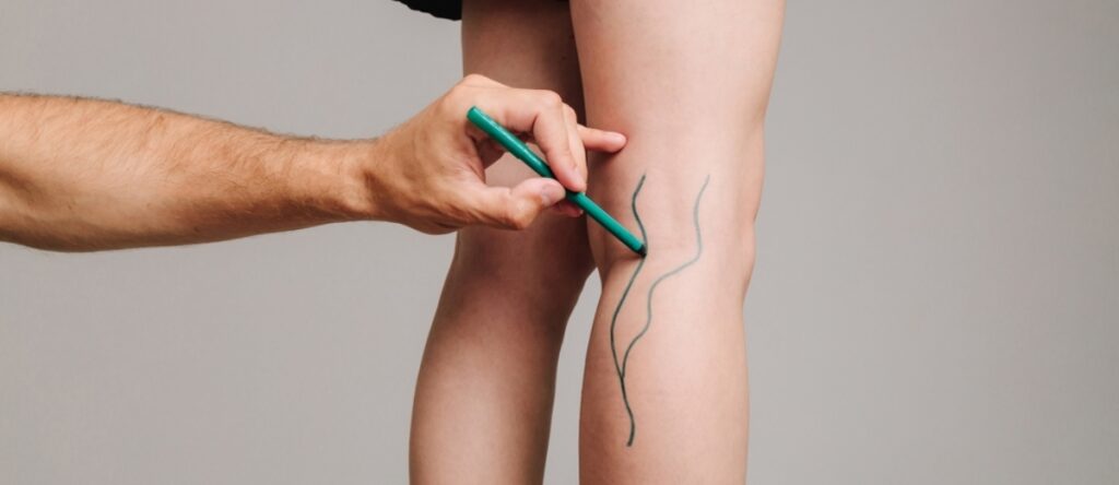 trombosi alle gambe santagostino monza