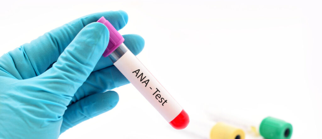 anticorpi antinucleo santagostino monza