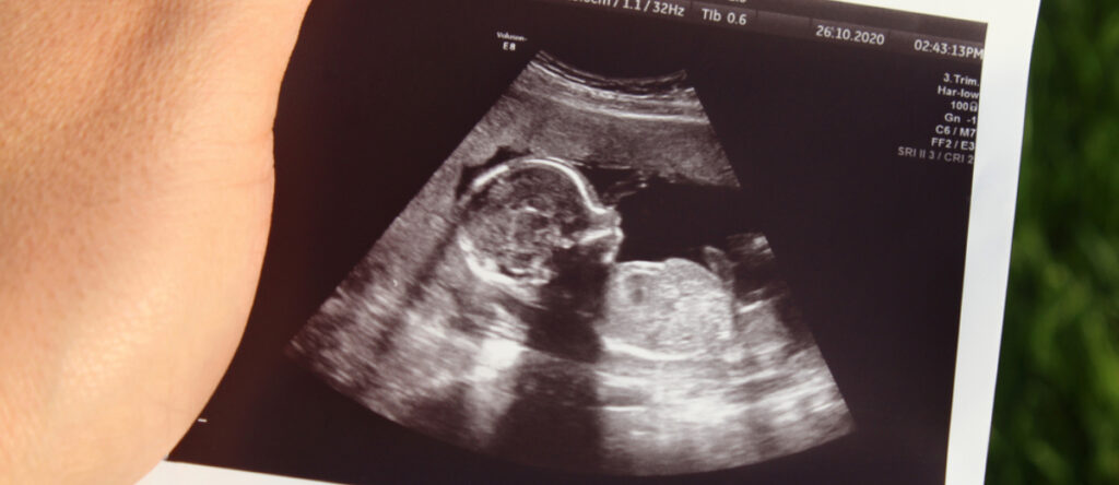 ecografia morfologica santagostino monza