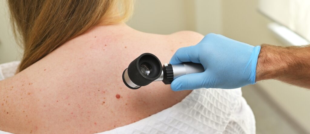 melanoma santagostino monza
