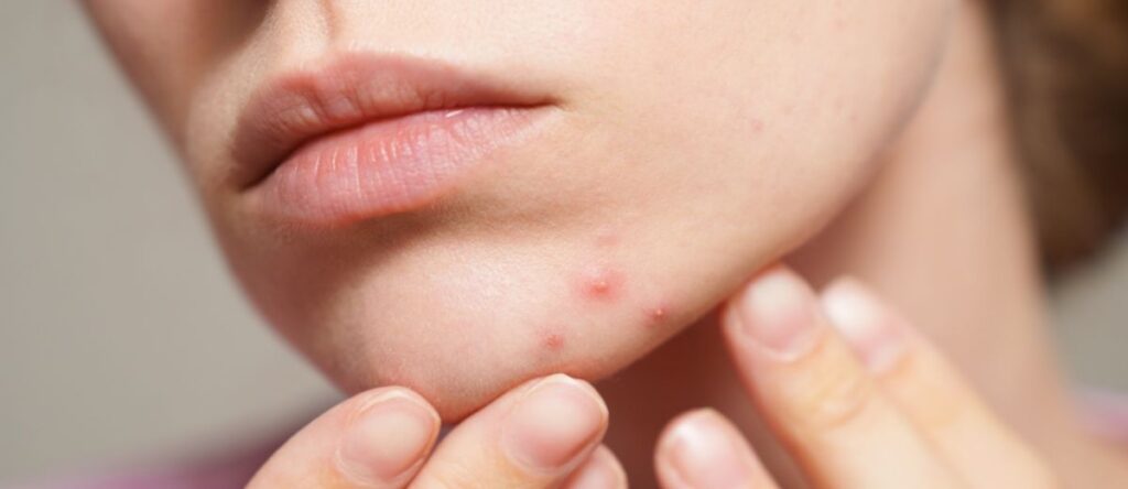 acne monza